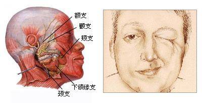 面肌痉挛最新最佳治疗方法，中医独特之处的探索与实践