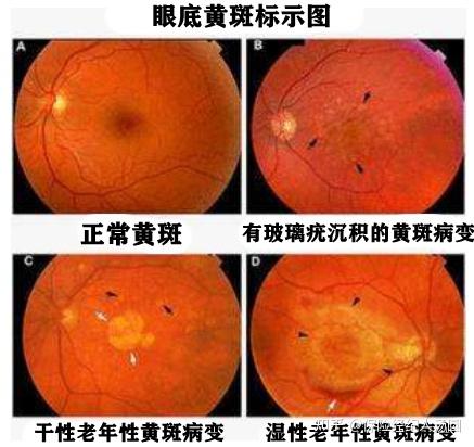 眼底黄斑病变治疗最有效最新方法